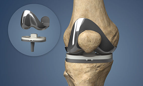 Knee replacement in nagpur